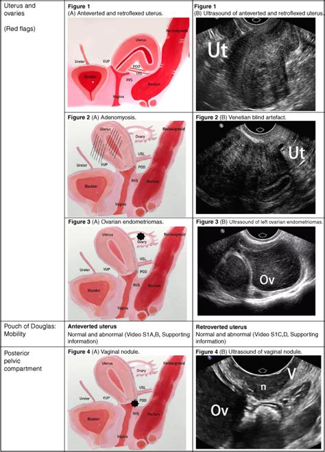 Anteverted Uterus – Radiology In Plain English.